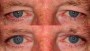 Before and after image of a 53-year-old person. Opacity is set to 0.7.