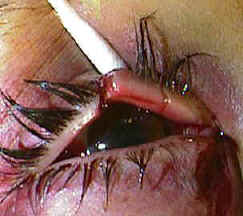 This photo below shows a patient who was hit in their right eye with a fist and who sustained a canalicular laceration.