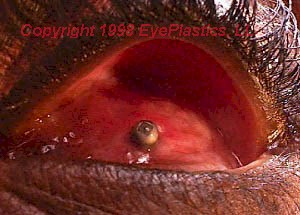 Enhance Prosthetic Eye Motility with
