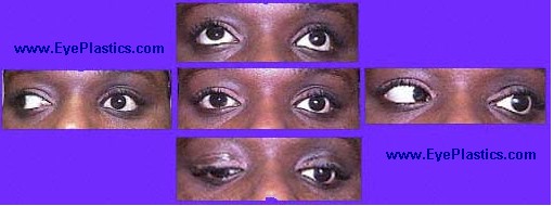 Enhance Prosthetic Eye Motility with
