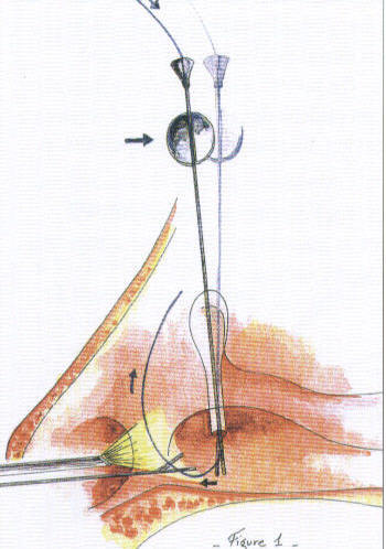 Ritleng mono-canalicular stent