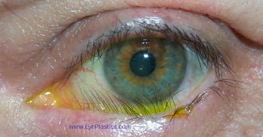 Trichiasis - Lashes pointing to the eye